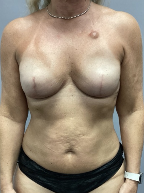 Breast Reconstruction Before & After Image