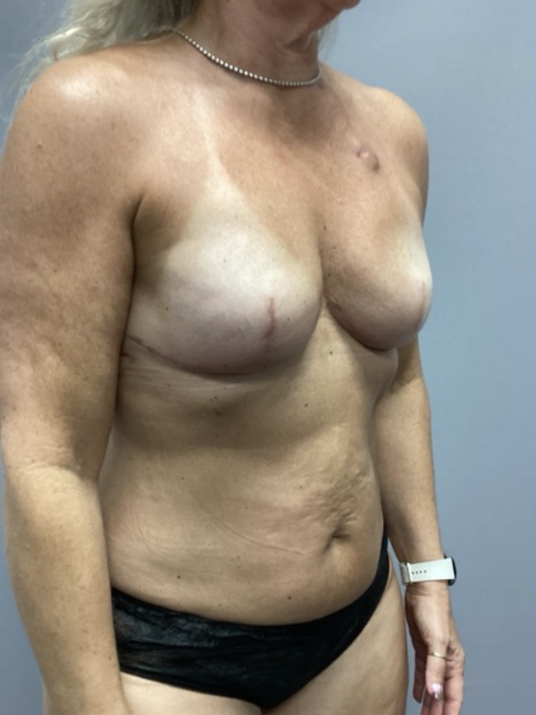 Breast Reconstruction Before & After Image