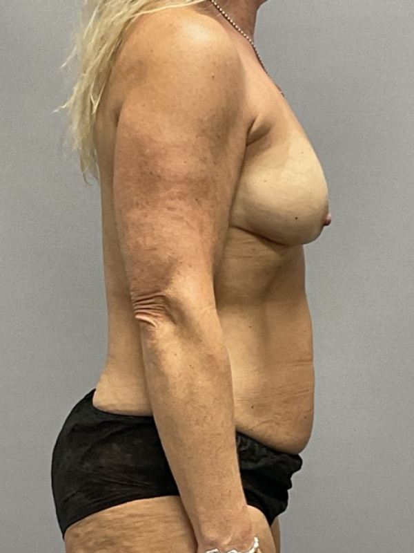 Breast Reconstruction Before & After Image
