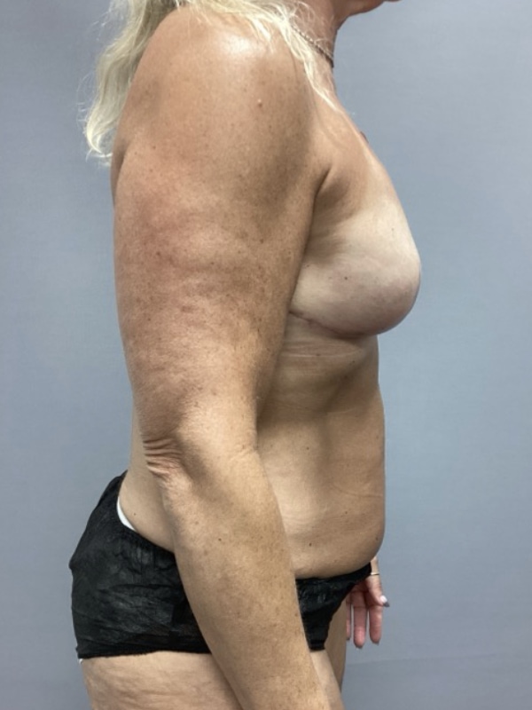 Breast Reconstruction Before & After Image