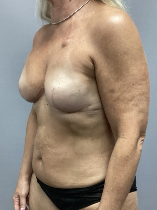 Breast Reconstruction Before & After Image
