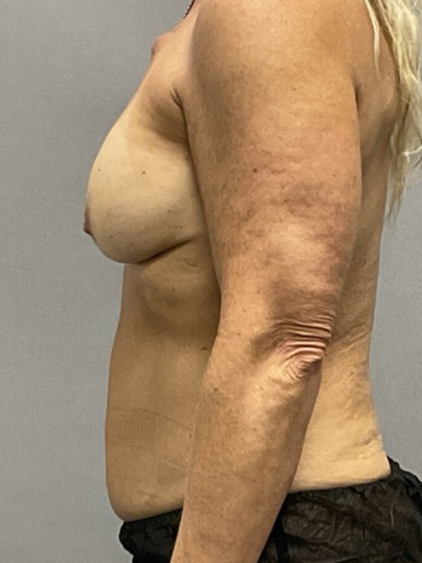 Breast Reconstruction Before & After Image