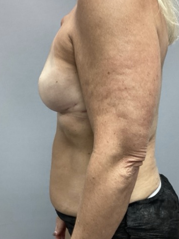Breast Reconstruction Before & After Image