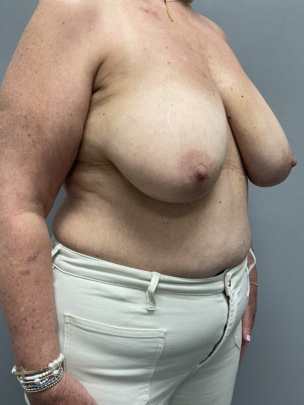 Breast Reconstruction Before & After Image