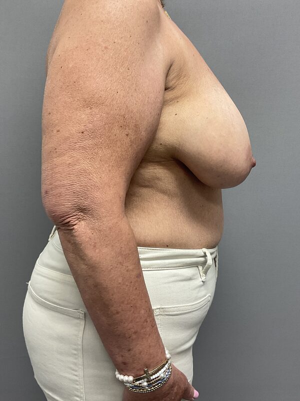 Breast Reconstruction Before & After Image