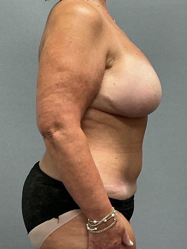Breast Reconstruction Before & After Image