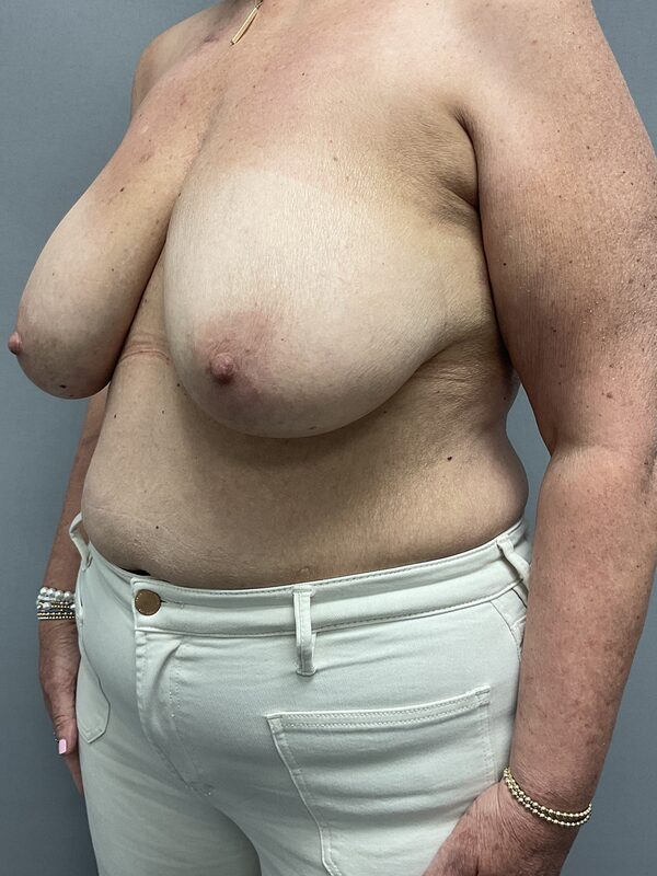 Breast Reconstruction Before & After Image