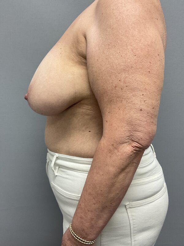 Breast Reconstruction Before & After Image