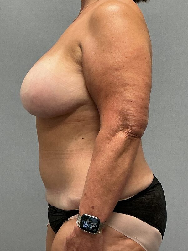 Breast Reconstruction Before & After Image