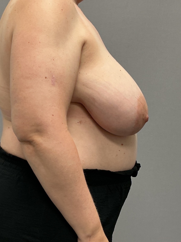 Breast Reconstruction Before & After Image