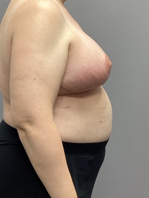 Breast Reconstruction Before & After Image
