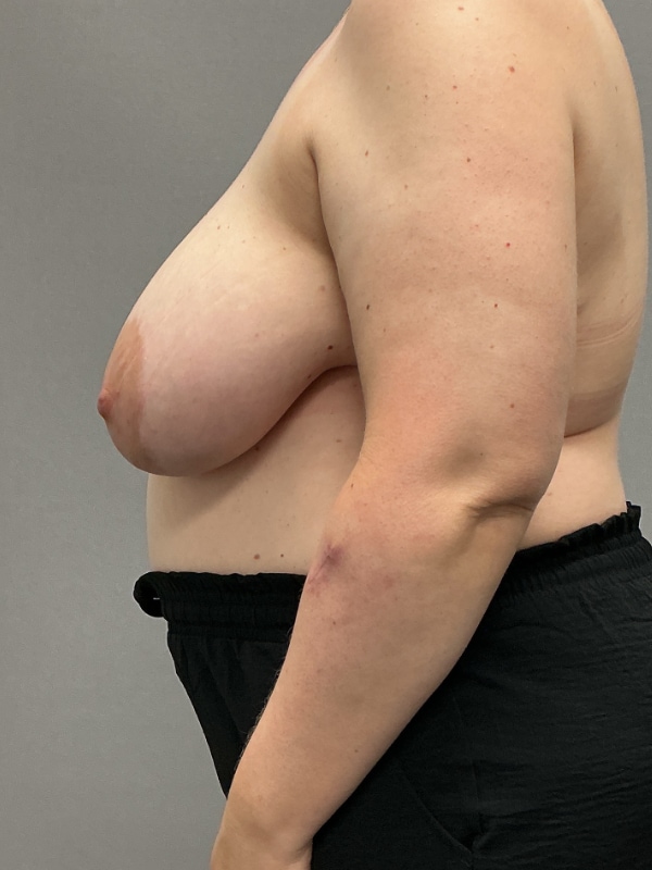 Breast Reconstruction Before & After Image