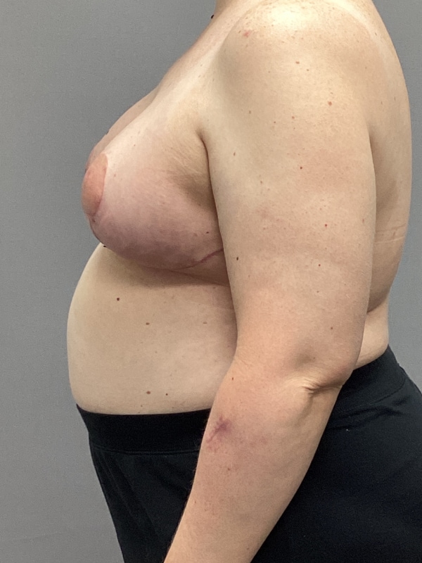 Breast Reconstruction Before & After Image
