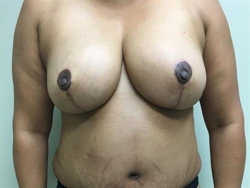 Breast Reduction Before & After Image