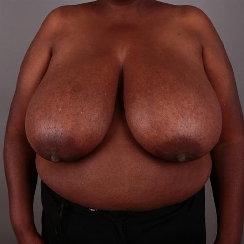 Breast Reduction Before & After Image