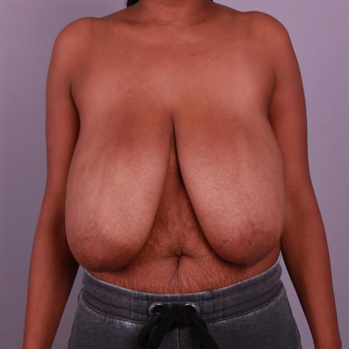 Breast Reduction Before & After Image