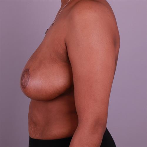 Breast Reduction Before & After Image