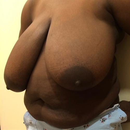 Breast Reduction Before & After Image