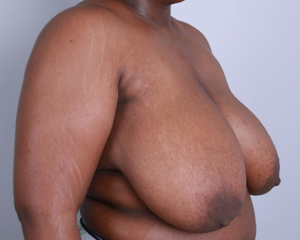 Breast Reduction Before & After Image