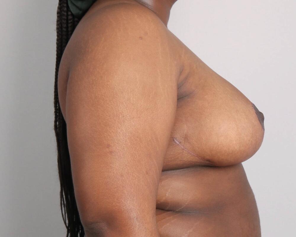 Breast Reduction Before & After Image