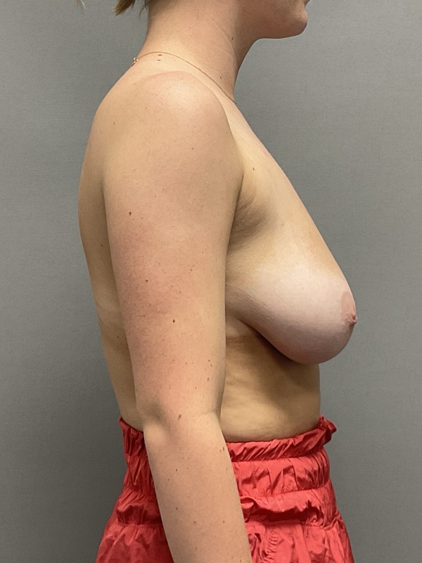 Breast Reduction Before & After Image