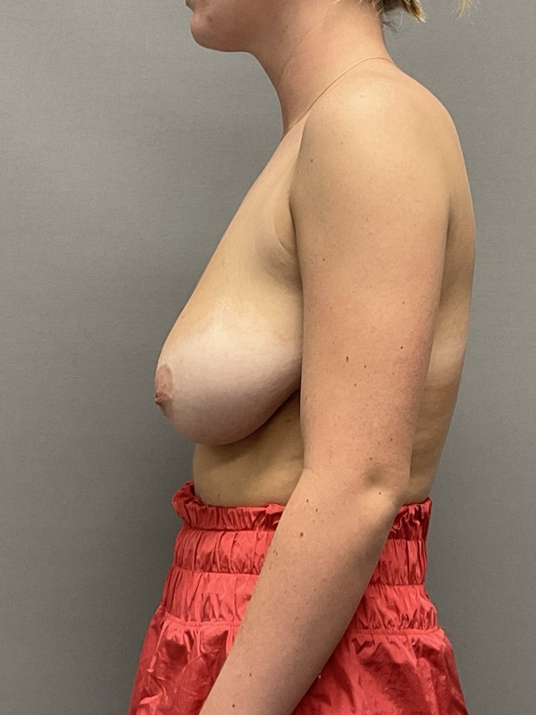 Breast Reduction Before & After Image