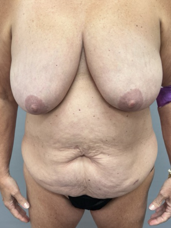 Breast Reduction Before & After Image