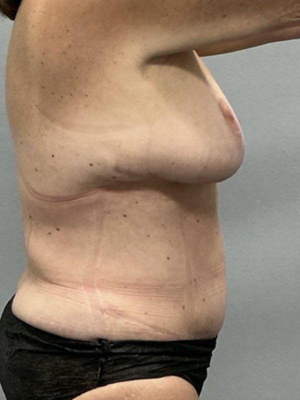 Breast Reduction Before & After Image