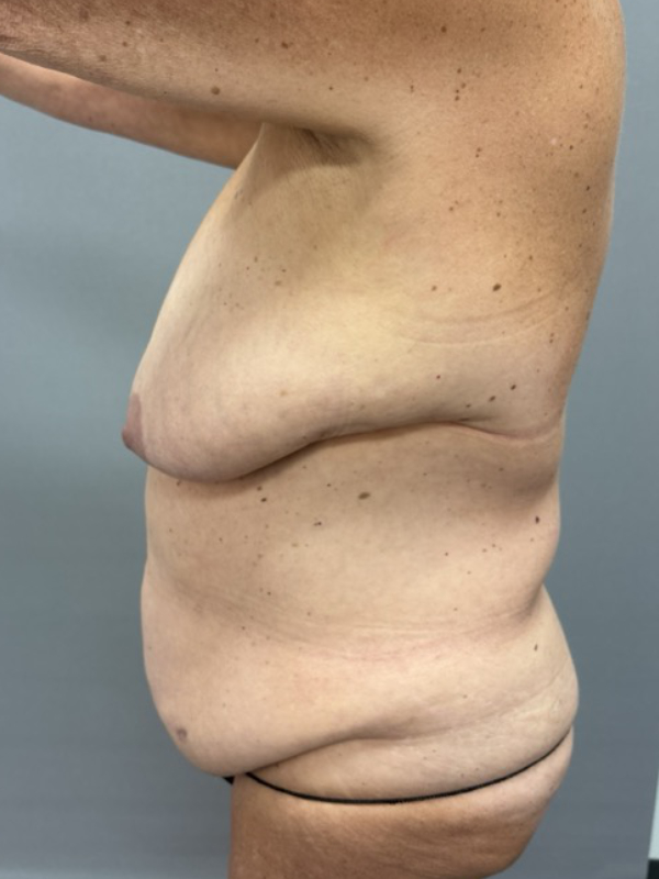 Breast Reduction Before & After Image
