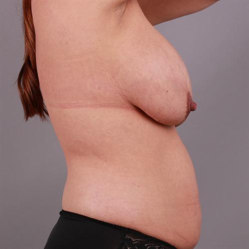 Breast Revision Surgery Before & After Image