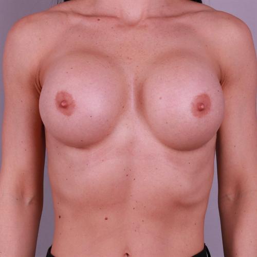 Breast Revision Surgery Before & After Image