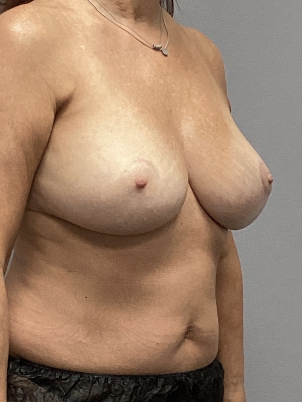 Breast Revision Surgery Before & After Image