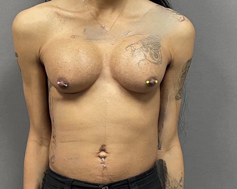 Male to Female Top Surgery Before & After Image