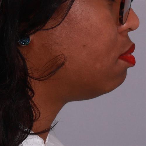 Chin Augmentation Before & After Image