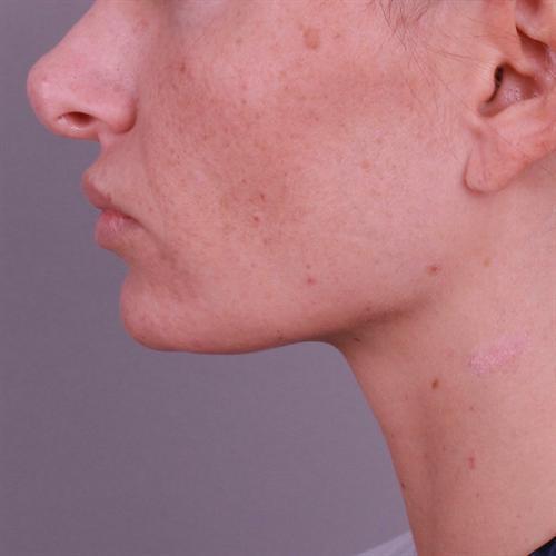 Chin Augmentation Before & After Image