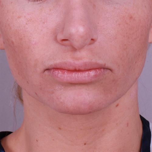 Chin Augmentation Before & After Image