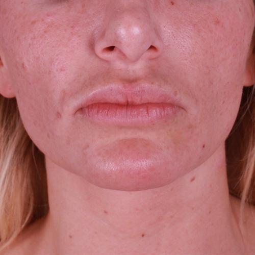 Chin Augmentation Before & After Image