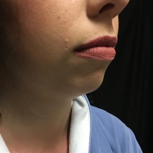 Chin Augmentation Before & After Image