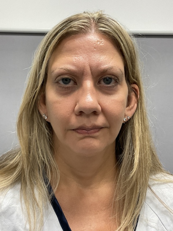 Chin Augmentation Before & After Image