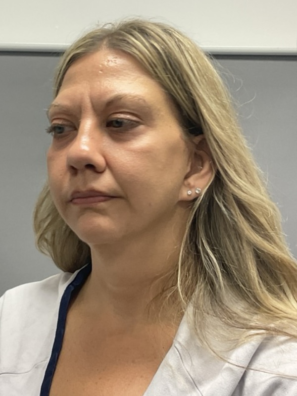 Chin Augmentation Before & After Image