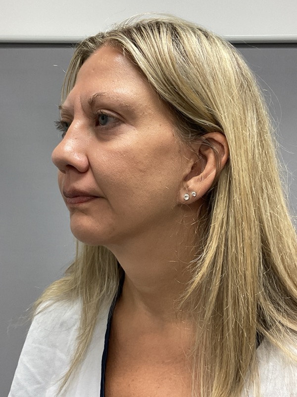 Chin Augmentation Before & After Image