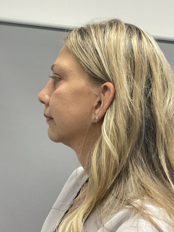 Chin Augmentation Before & After Image