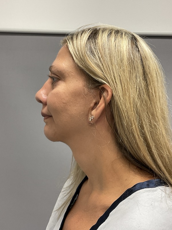 Chin Augmentation Before & After Image