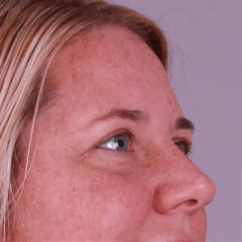 Blepharoplasty Before & After Image