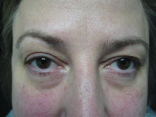 Blepharoplasty Before & After Image