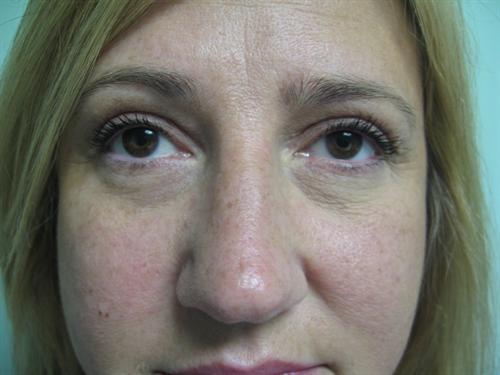 Blepharoplasty Before & After Image