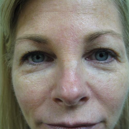 Blepharoplasty Before & After Image