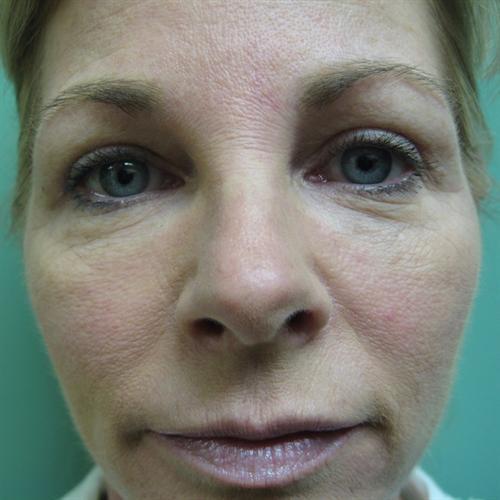 Blepharoplasty Before & After Image