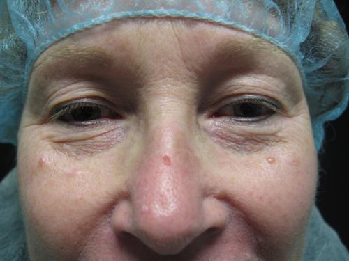 Blepharoplasty Before & After Image