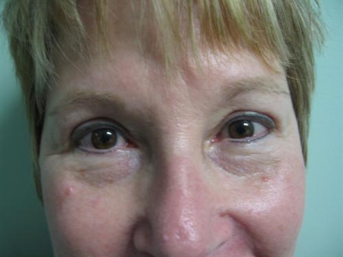 Blepharoplasty Before & After Image